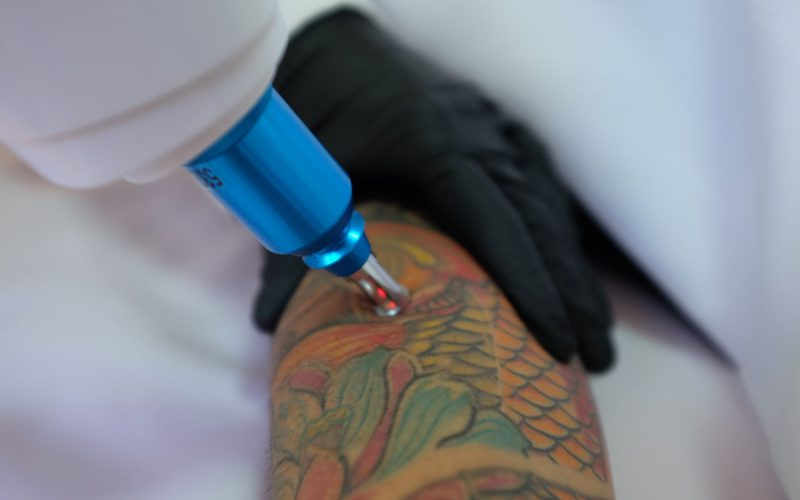 rimozione tatuaggi colorati