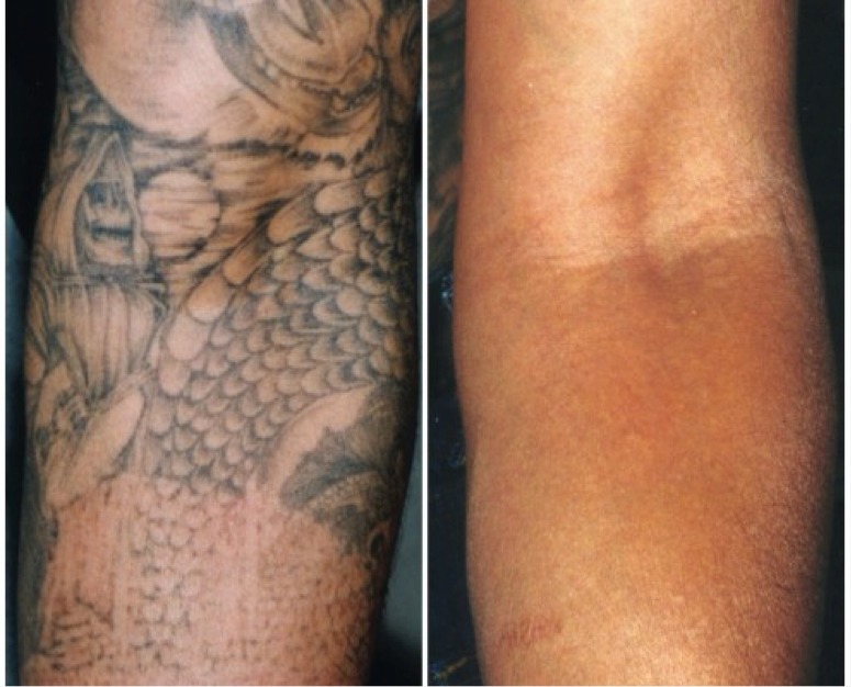 foto prima e dopo rimozione tatuaggio braccio Paolo