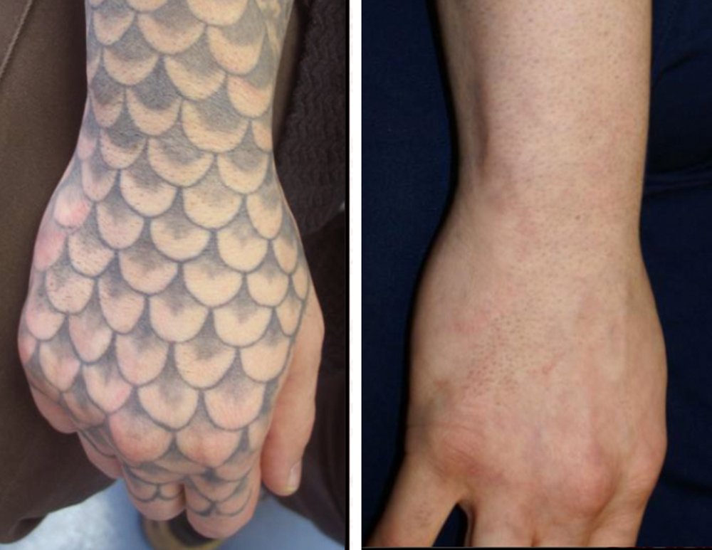 foto prima e dopo rimozione tatuaggio mano Lorenzo