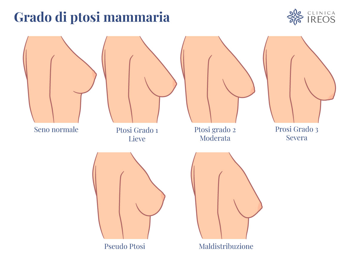 fasi di progressione ptosi mammaria