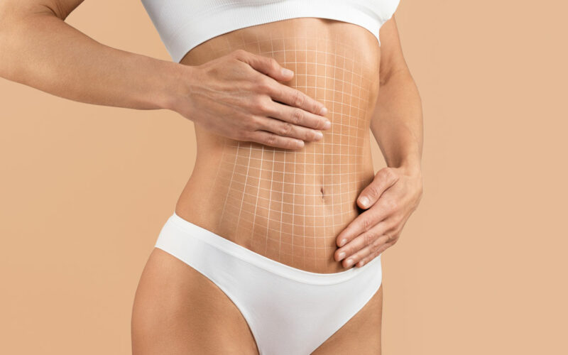 Tummy Tuck