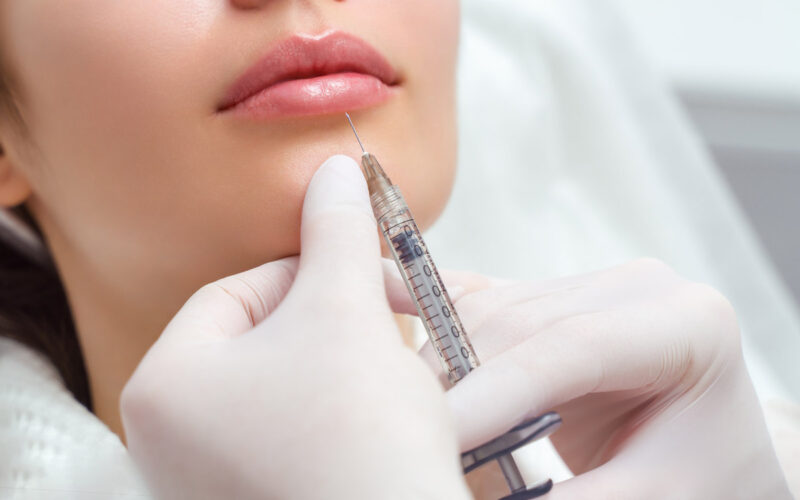 Filler Labbra: la guida definitiva per labbra naturalmente belle