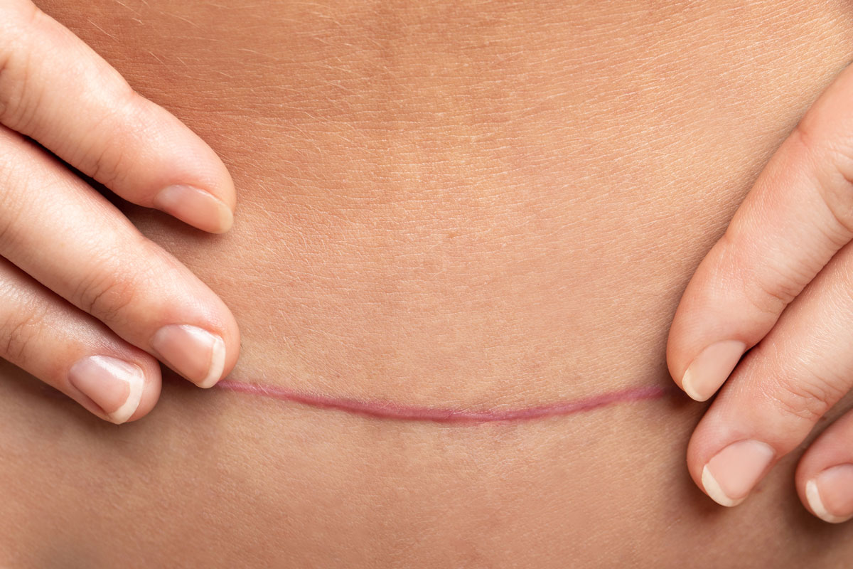 cicatrice post parto e osteopatia