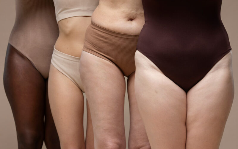lipedema
