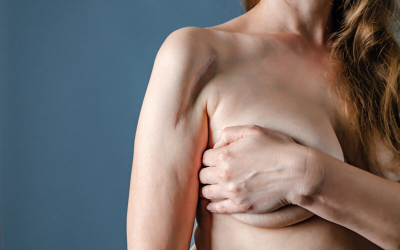 seno più alto dell'altro dopo la mastoplastica