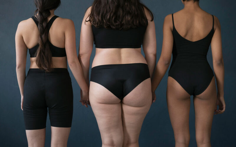 Cause del lipedema: perché viene e quali sono i fattori di rischio