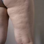 lipedema gambe