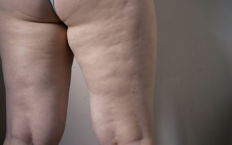 Lipedema alle gambe: caratteristiche, segnali e gestione