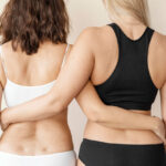 lipedema testimonianze
