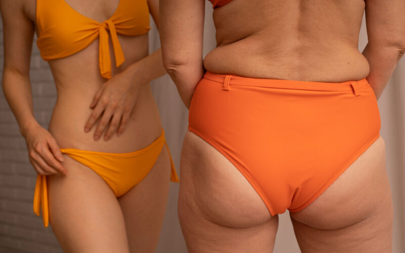 liposuzione lipedema