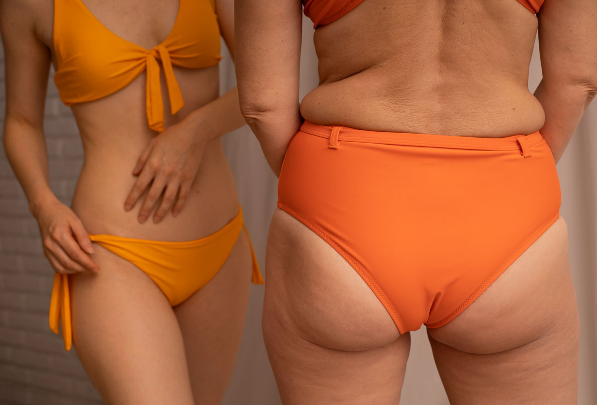 liposuzione lipedema