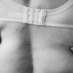 riconoscere Lipedema