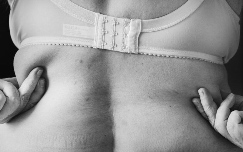 Come riconoscere il lipedema: segni, foto e checklist orientativa