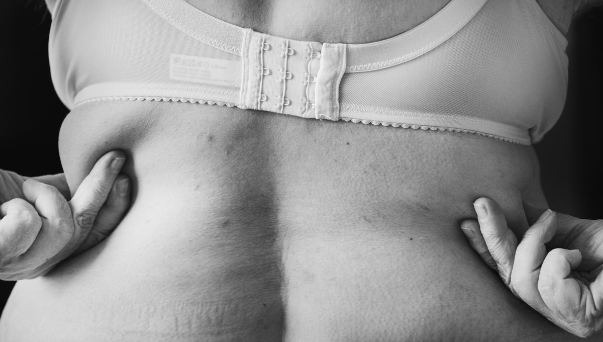 riconoscere Lipedema