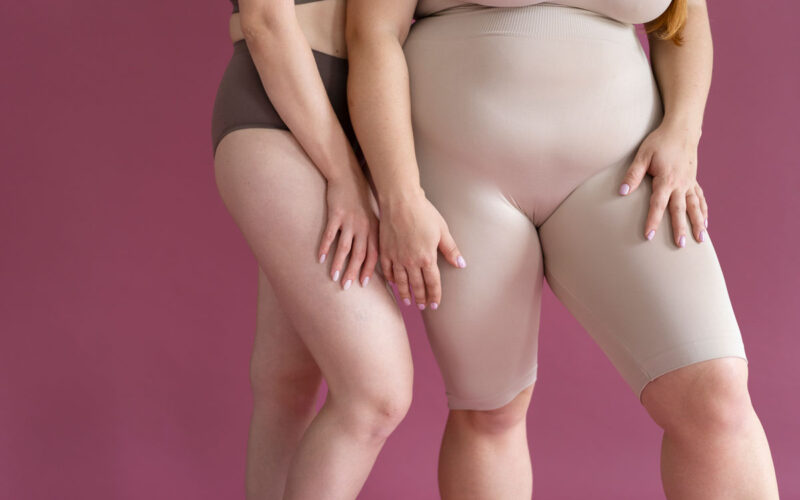 Sintomi del lipedema: come riconoscerli e quando chiedere una visita