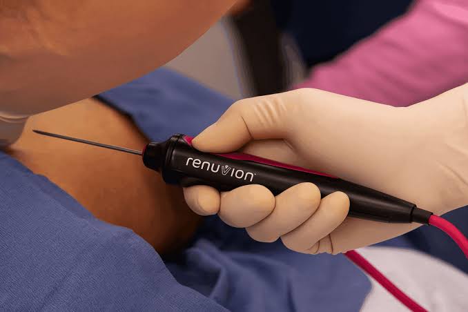 liposuzione con renuvion a Firenze
